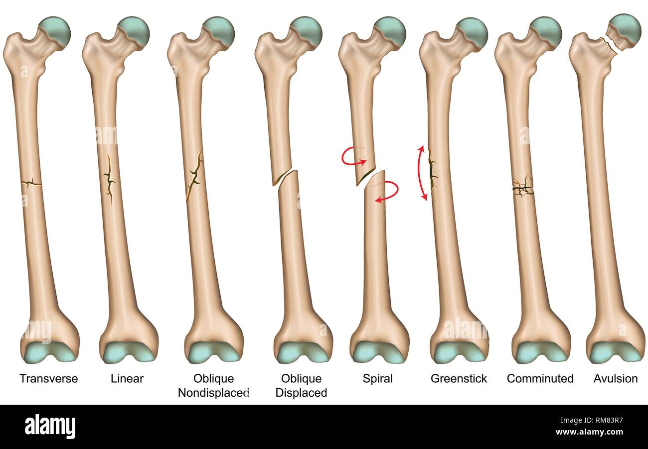 Bone fracture types medical vector illustration Stock Vector