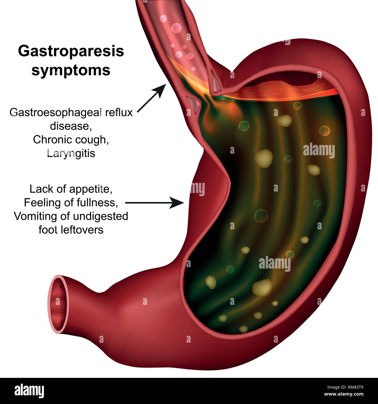 Gastroparesis hires stock photography and images Alamy