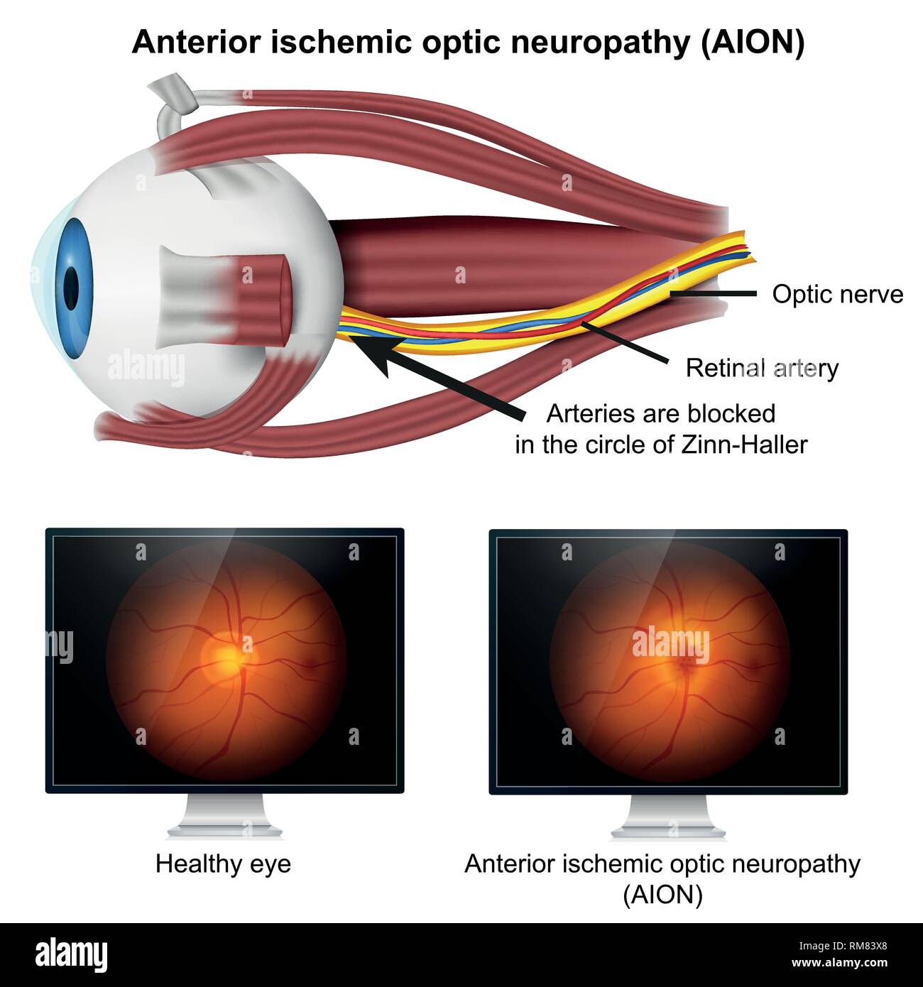 Ishemic optic neuropathy medical 3d vector illustration on white background Stock Vector