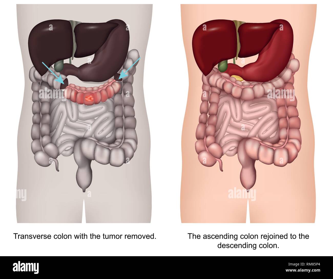 Sigmoid colon resection Cut Out Stock Images & Pictures - Alamy
