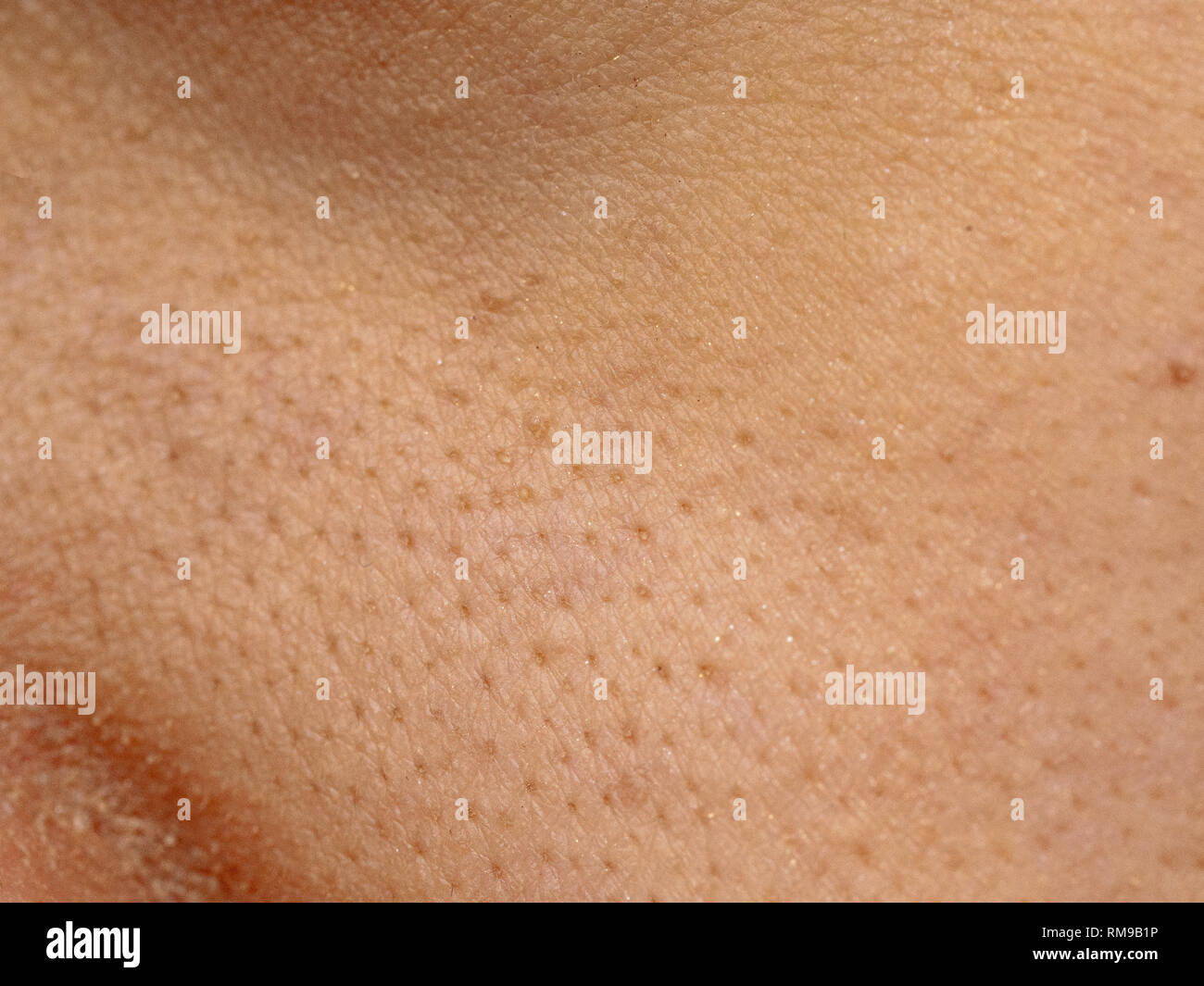 close up wide pores skin on dry face of Asian woman, Female nose and cheek skin problem, large pores, whitehead and blackhead pimple Stock Photo