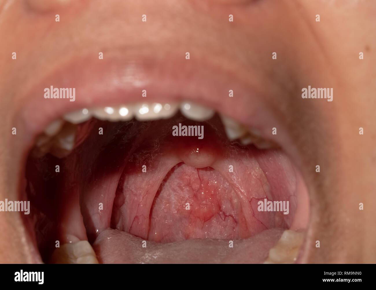 Sore throat with throat swollen. Closeup open mouth with posterior pharyngeal wall swelling and uvula and tonsil. Influenza follicles in the posterior Stock Photo