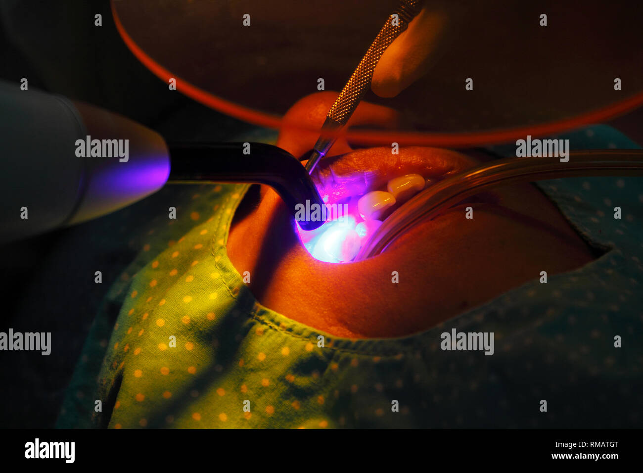 Dentist use a dental curing light (blue wand) to polymerization of light cure resin based composite (white filling) in patient mouth Stock Photo