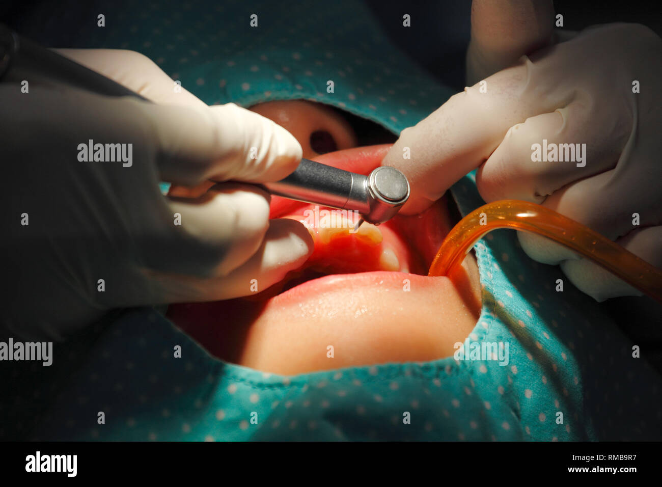 Closeup dental deep cleaning by scaling plaque from patient teeth Stock Photo
