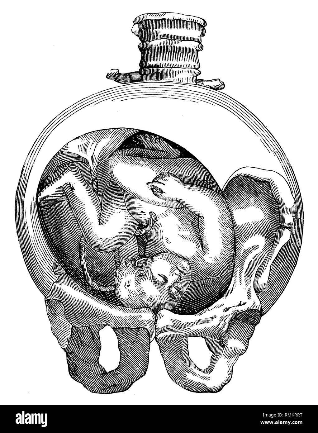 Fetus in the uterus. Facial: The forehead rests on the cervix,   1900 Stock Photo