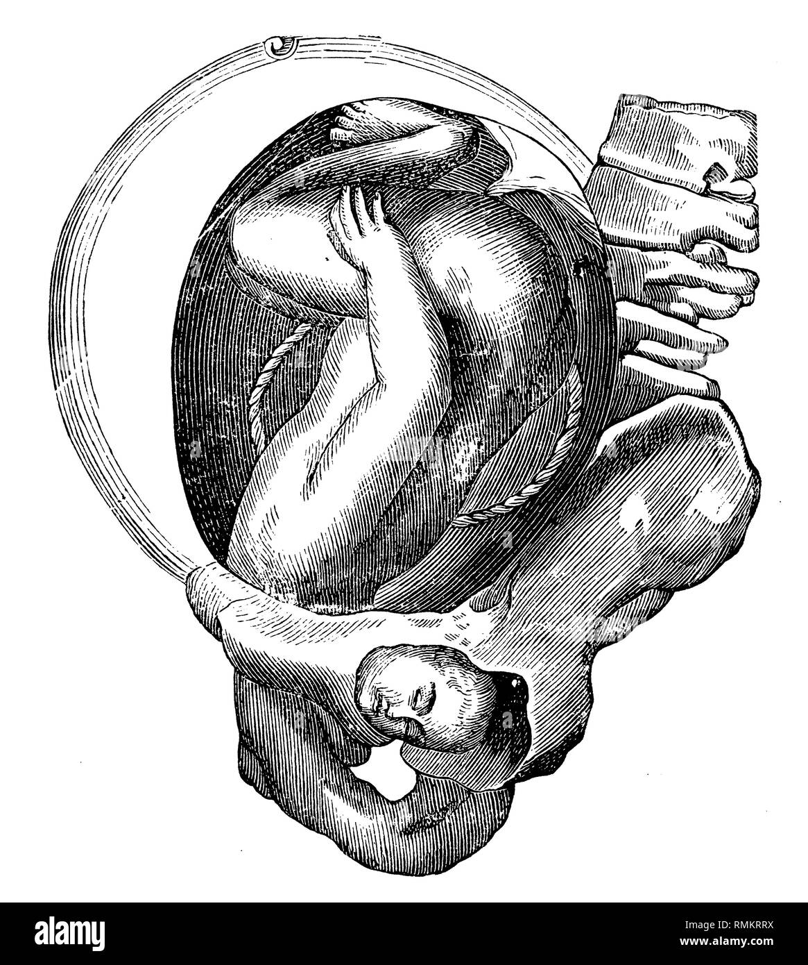 Fetus in the uterus. Face birth, side view,   1900 Stock Photo