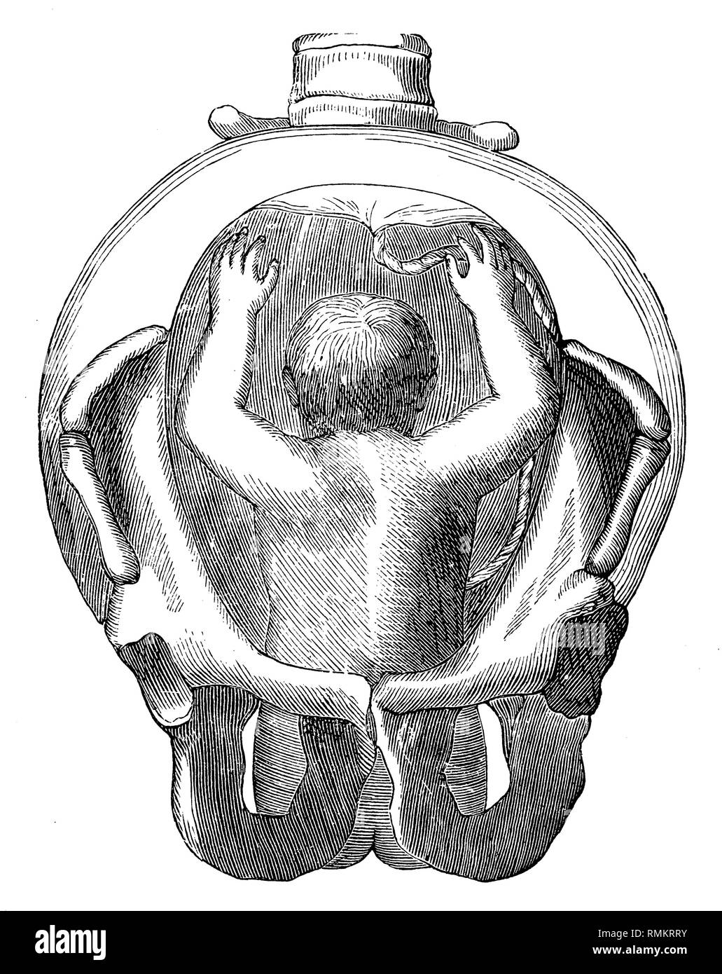 Fetus in the uterus. Breech. the rump comes through the pelvic outlet,   1900 Stock Photo