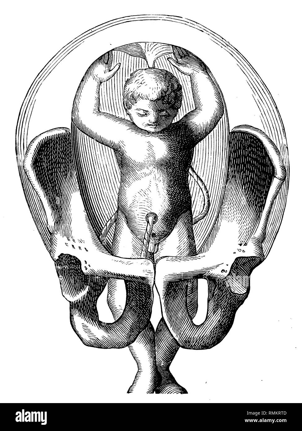 Fetus in the uterus. Fußgeburt. The feet are already kicking through the pelvic outlet,   1900 Stock Photo