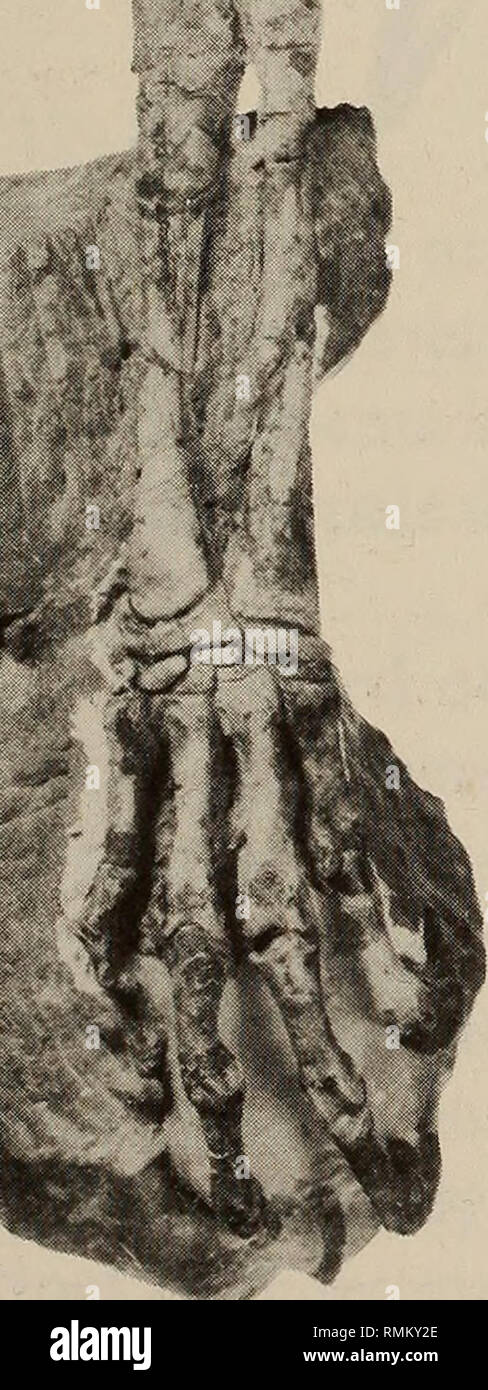 Medial supracondylar ridge hi-res stock photography and images - Alamy