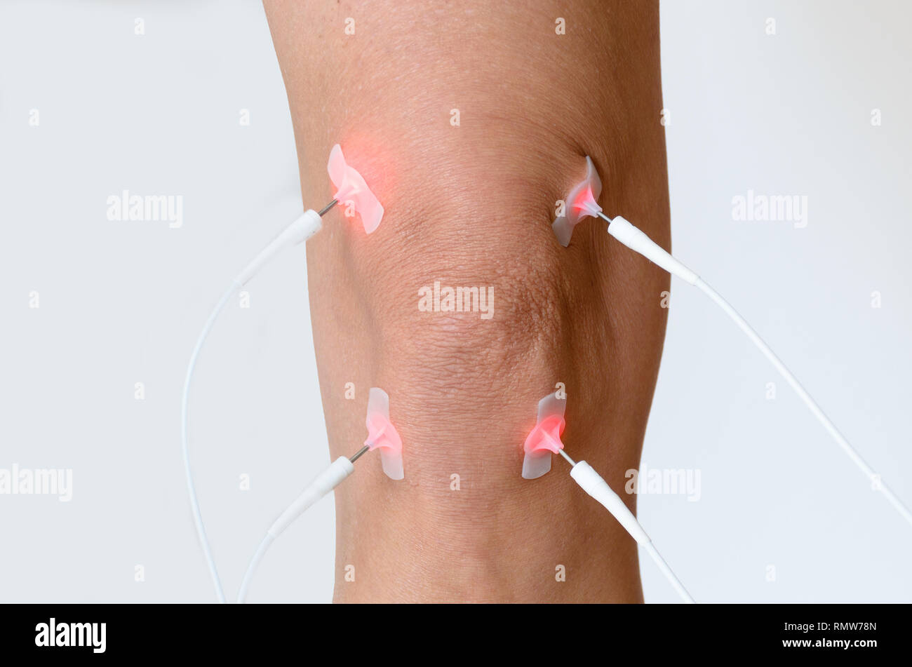 Patient having electrode therapy, or electrical muscle stimulation, on a  knee joint using electrical stimulation to treat muscle pain and prevent  atro Stock Photo - Alamy