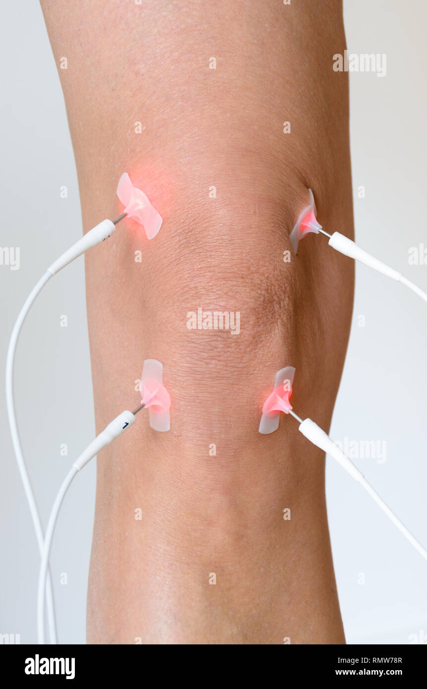 https://c8.alamy.com/comp/RMW78R/patient-having-electrode-therapy-or-electrical-muscle-stimulation-on-a-knee-joint-using-electrical-stimulation-to-treat-muscle-pain-and-prevent-atro-RMW78R.jpg
