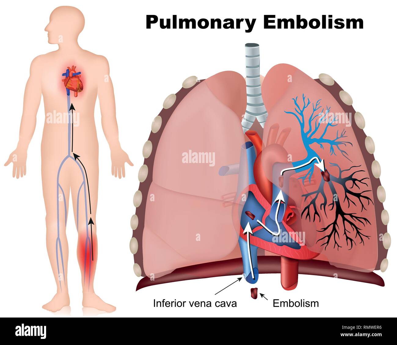 Pulmonary embolism Stock Vector Images Alamy