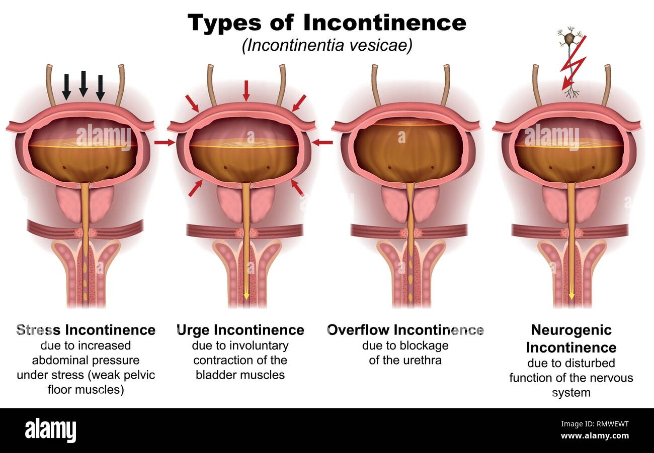 Types of incontinence 3d medical vector illustration on white