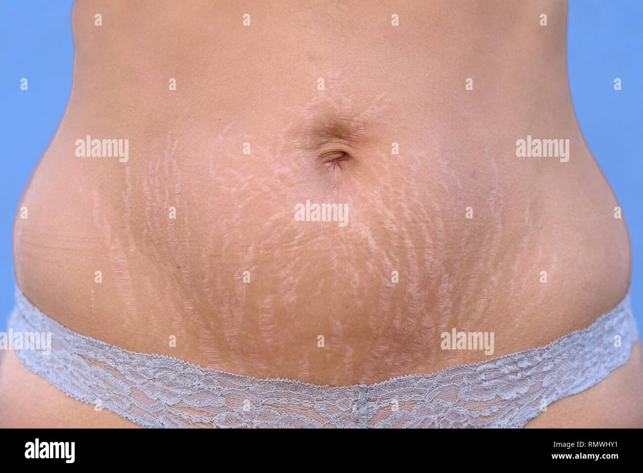 Woman Displaying Stretch Marks On Her Abdomen After Pregnancy Caused By Tearing Of The Dermis Layer Of The Skin And Showing As Red Discolorations Clo Stock Photo Alamy