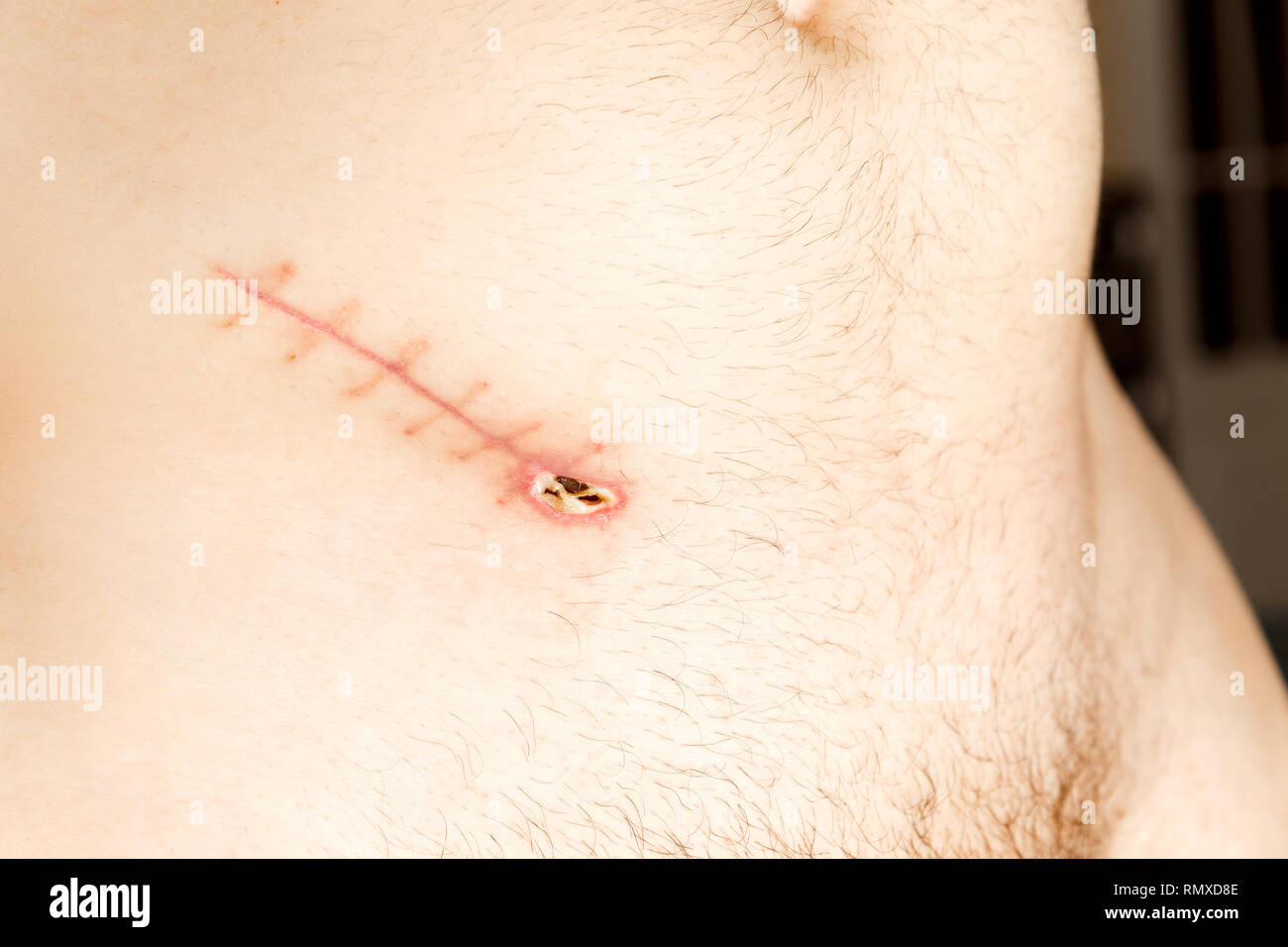 normal appendicitis scar