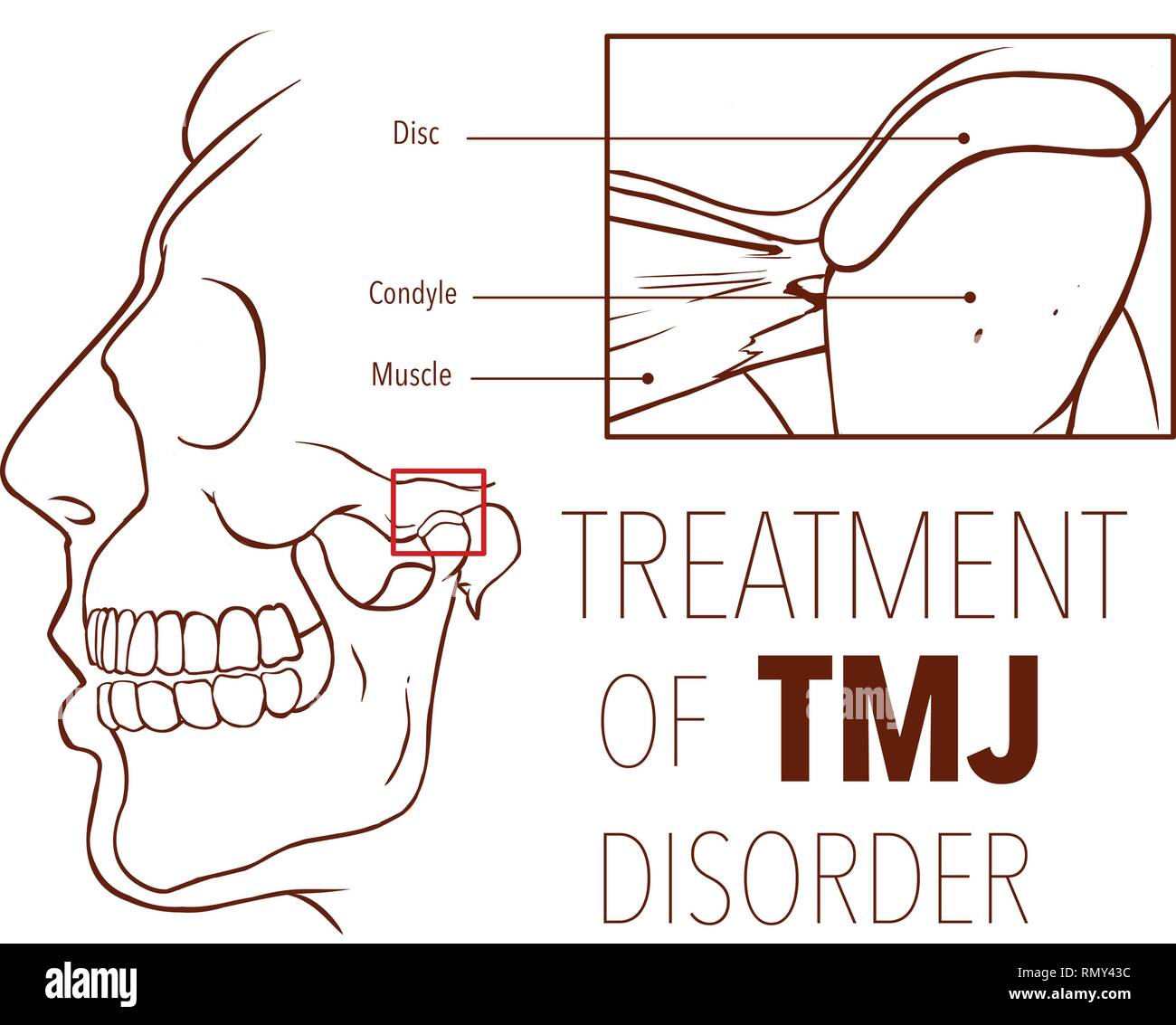 Vector illustration  of treatment of tmj disorder Stock Vector