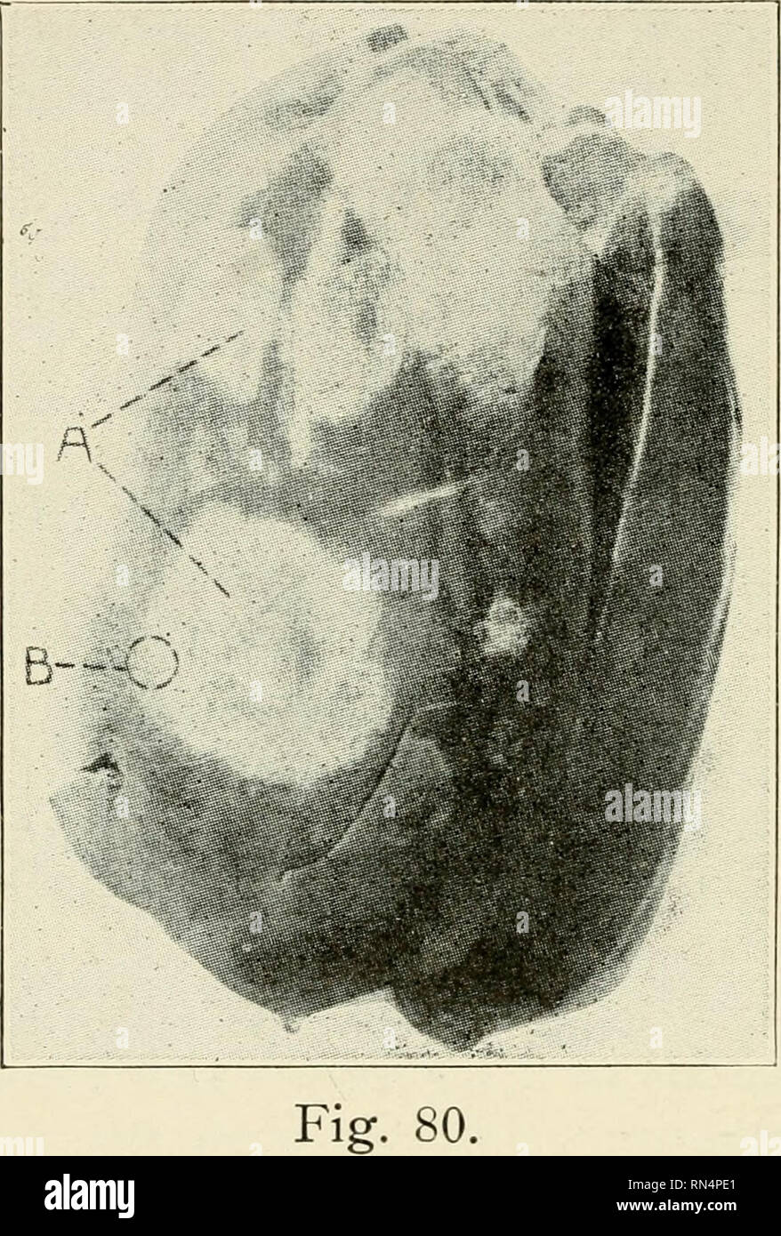. Animal parasites and parasitic diseases. Horses; Domestic animals -- Parasites; Veterinary medicine. 218 PARASITOLOGY.. Fig. 80.—Liver from a case of Black-Head. En- tero hepatitis, in a turkey. Photograph. This liver v^eighed 452 grams (about one pound) ; a, indicates the yellowish-white necrotic areas, lesions of the disease.—From Kaupp's Diseases of Poultry.. Please note that these images are extracted from scanned page images that may have been digitally enhanced for readability - coloration and appearance of these illustrations may not perfectly resemble the original work.. Kaupp, B. F. Stock Photo