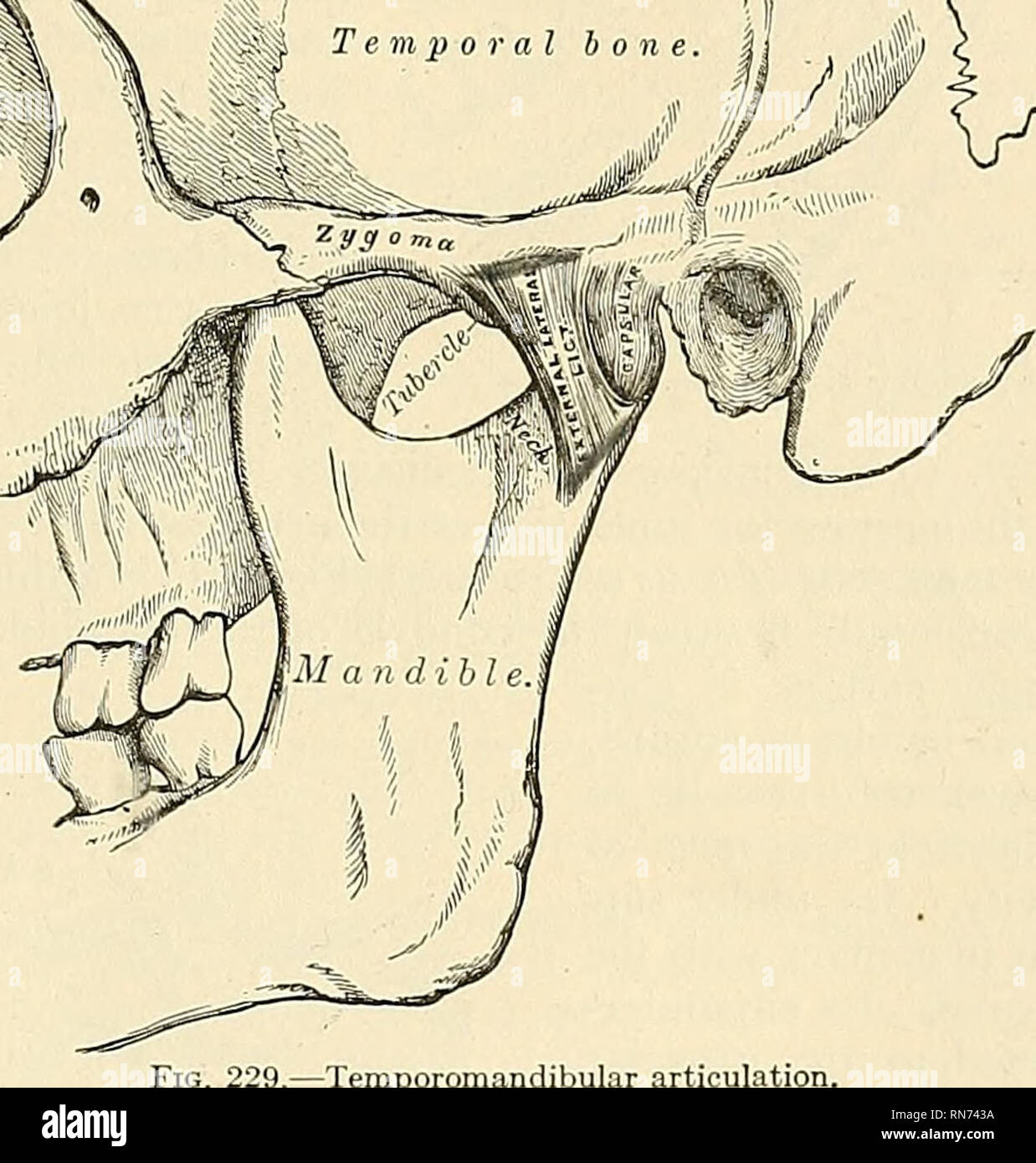 . Anatomy, descriptive and applied. Anatomy. TEMPOBOMANDIBULAR ARTICULATION 279 V. Temporomandibular Articiilation (Articulatio Mandibularis). This is a ginglymo-arthrodial joint; the parts entering into its formation on each side are, above, the anterior part of the glenoid cavity of the temporal bone and the eminentia articularis; and, below, the condyle of the mandible. The ligaments are the following: External Lateral. Internal Lateral. Articular Disk Stylomandibular. Capsular. The external lateral ligament {ligamenium temporomaitdibulare) (Fig. 229) is a short, thin, and narrow fasciculus Stock Photo