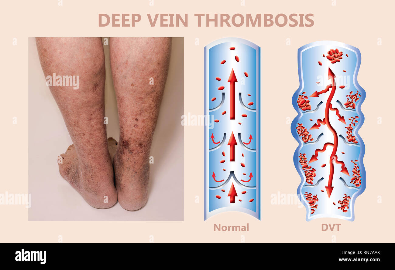 blood clot in leg ultrasound