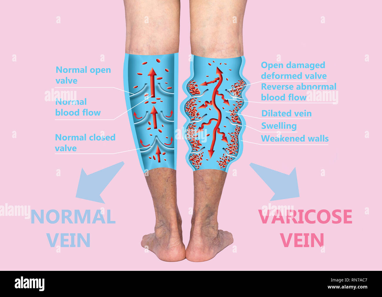 Varicose veins on a female senior legs. The structure of normal and varicose veins. Stock Photo