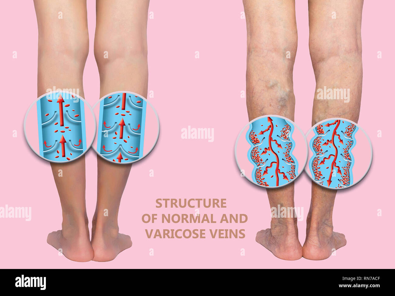 Varicose vein on a female senior legs. The structure of normal and varicose  veins. Concept of dry skin, old senior people and deep vein thrombosis or  Stock Photo - Alamy