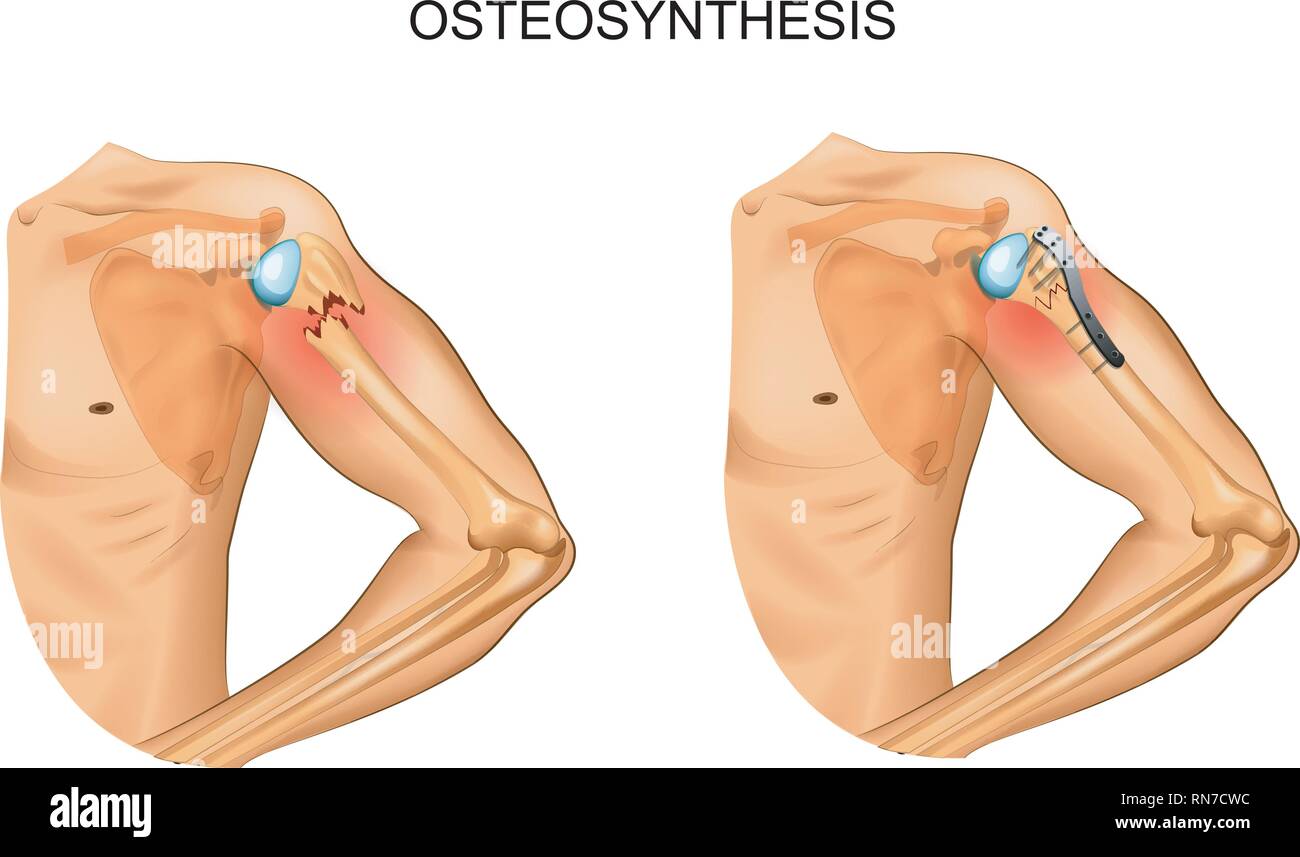 vector illustration of osteosynthesis in the fracture of the humerus head Stock Vector