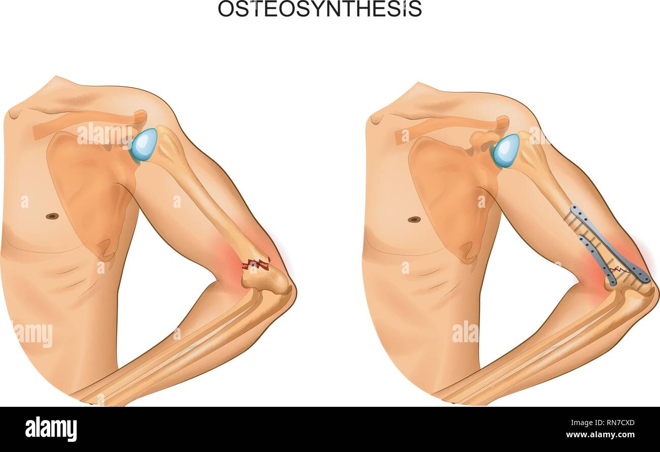 vector illustration of osteosynthesis in fracture of distal humerus Stock Vector