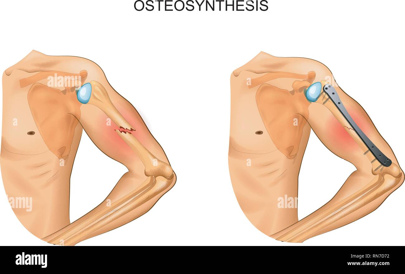 vector illustration of osteosynthesis of the body of the humerus Stock Vector