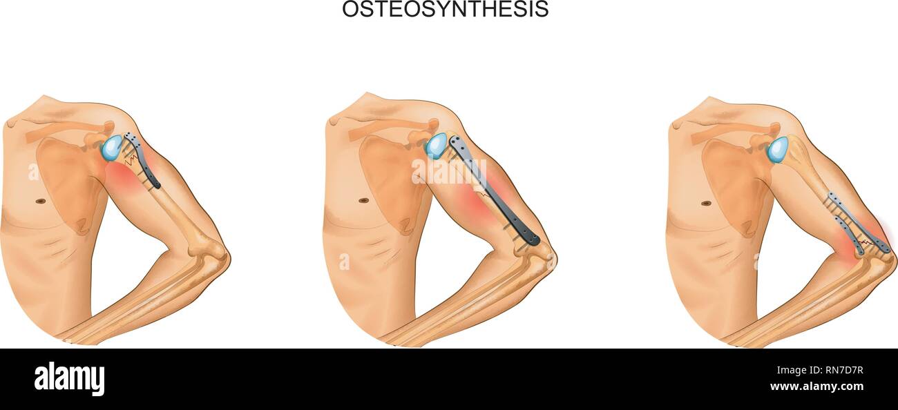 vector illustration of osteosynthesis of the humerus Stock Vector