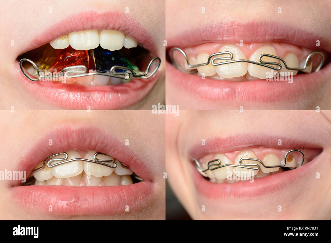 Close up mouth of crooked teeth with braces Toothbrush in the