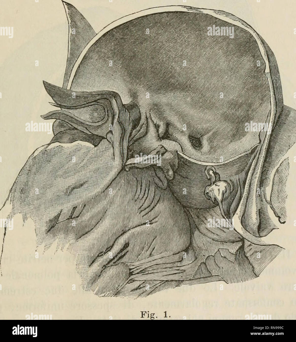 . Anatomischer Anzeiger. Anatomy, Comparative; Anatomy, Comparative. 117 3. Le anomalie numeriche delle valvole seiniluiiari del cuore; la loro genesi ed i loro rapportl colle affezioni della yita estrauterina. (Gazzetta delle Cliaiche, 1886.) Von Maetinotti. (Autorreferat.) A complemento di un lavoro precedeotemente pubblicato su questo argomentoO ho descritto tre nuovi casi di queste anomalie da me raccolti.. Oss.°' I&quot; (Fig^ l^. Uomo di 50 anni, morto per frattura delle coste. Cuore destro sano. Cuore sinistro ipertrofico. — Sull'orifizio aortico 1) Maetinotti e Spebino , Sulle anomalie Stock Photo