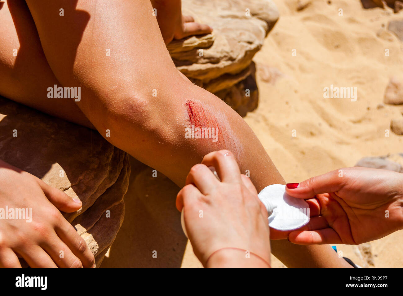 Helping disinfecting the big bleeding scratch injury on the leg during the hiking tour in the desert Stock Photo