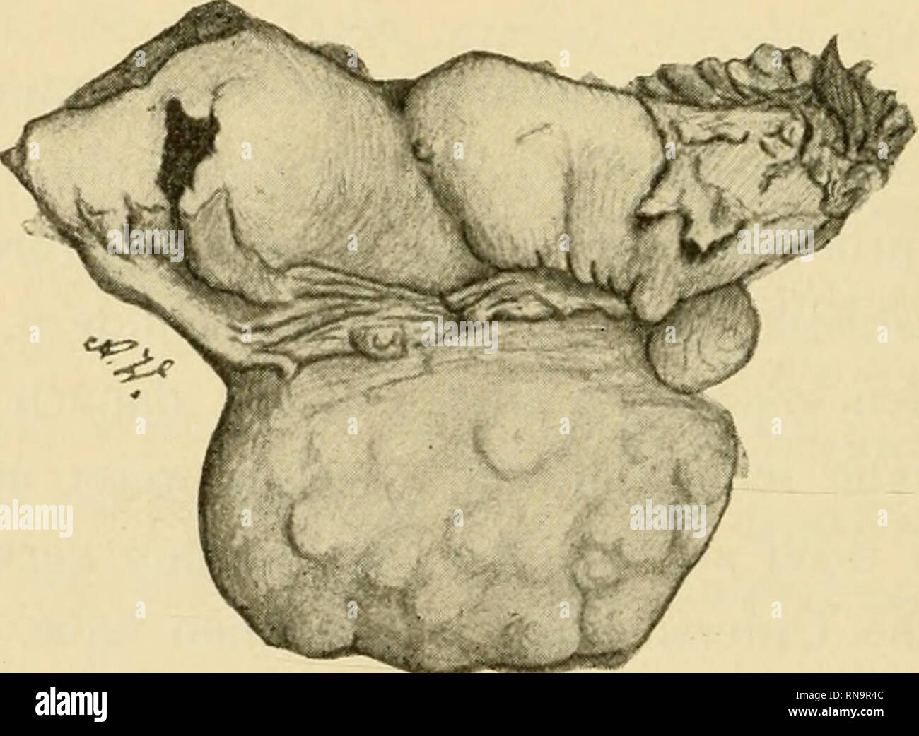 . Anatomische Hefte. A. WALLGREN, III. Kasuistik. Fall I. Das Präparat stammt von einer Operation, die am 19. XL 1899 von Prof. Heinricius in der geburtshülflich-gynäkologischen Klinik an einer Frau ausgeführt wurde, die kurz vorher in be- wusstlosem Zustand mit allen Anzeichen einer durch eine rup- turierte gravide Tube hervorgerufene interne Blutung aufge- nommen worden war. Die Anamnese giebt an, dass die Frau nach ihrer letzten Niederkunft am 26. V. 1899 drei Mal mit un- regelmässigen Intervallen und das letzte Mal ca. drei Monate vor der Operation menstruiert hatte. Eine Woche vor der Ope Stock Photo