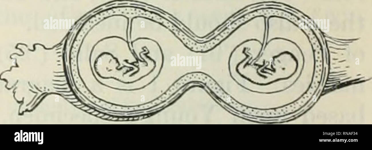The Anatomical record 1922-1923. Anatomy. 3 4 to 4 Stages illustrating  secondary chorionic fusion between dizygotie Figs. 1 tubal embryos. Fig. 1,  Young's specimen; Pulcher's specimen; fig. 4, Costa's specimen. fig.