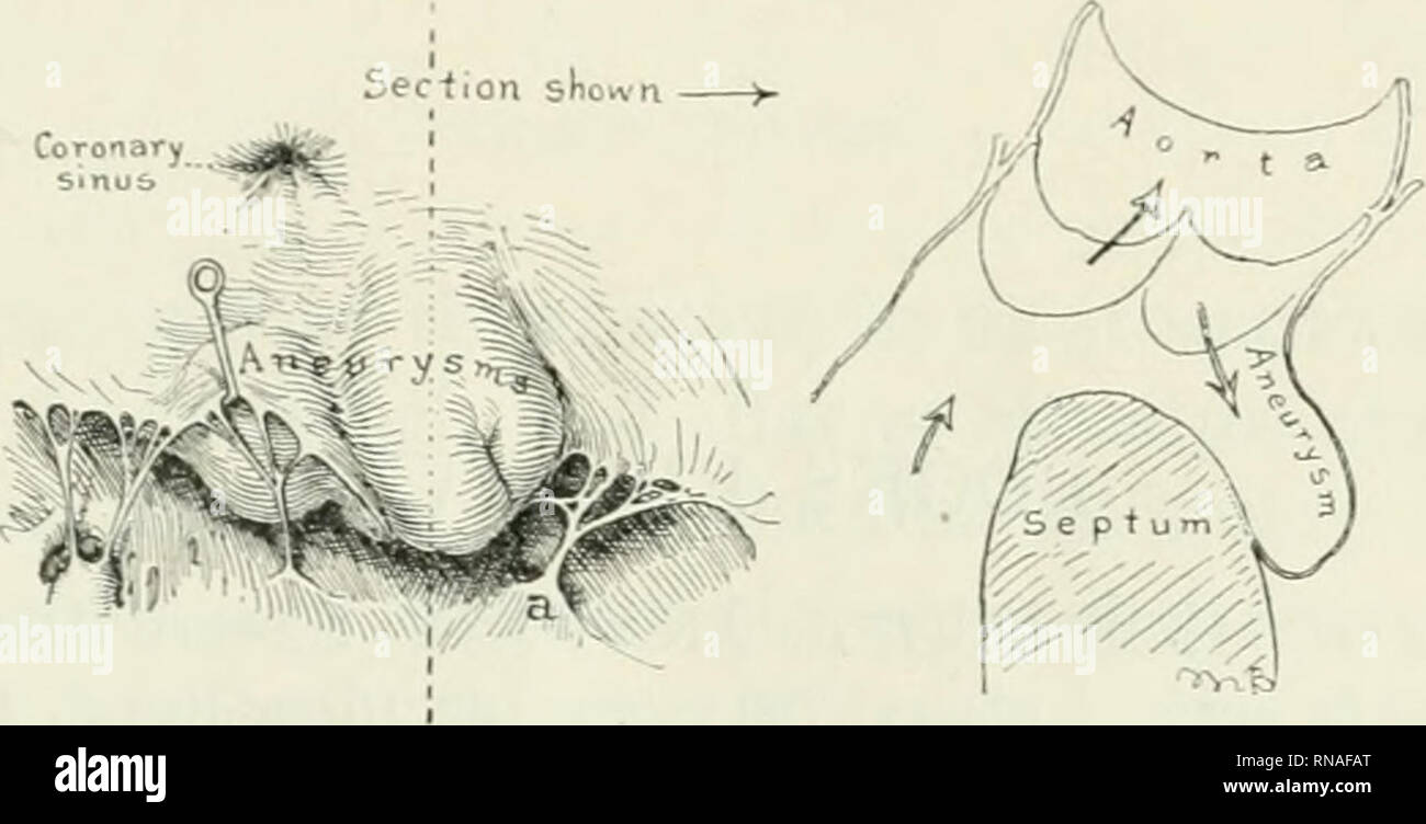 . The anatomical record. Anatomy; Anatomy. ANEURYSM OF THE MUMBKAXOUS SKPTUM 297 {w iiitorior sopluin is (lisplucod to tho left, thus voiikoniii{2; the iHcinhrimous scpluin wliich must hiive been placed in a hori- zontal positit)!). Ill my own ease the mitral and trieusi)i(l valves were somewhat thiekenetl but not sufficiently to warrant calling the condition due to endocarditis. Certainly there was no acute endocarditis present. However, from all that I can ascertain this type of anomaly can properly be traced back to an embryonic arrest of development in which the inferior septum did not m Stock Photo