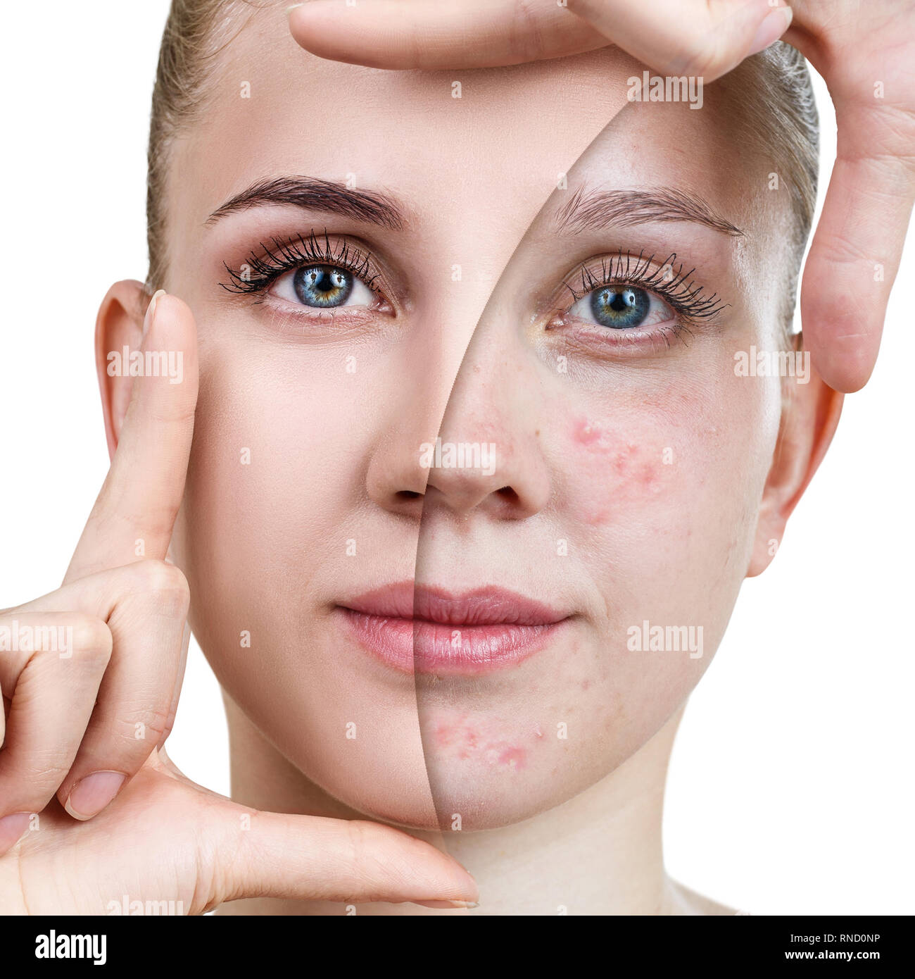 Young woman before and after skin treatment and makeup Stock Photo Alamy