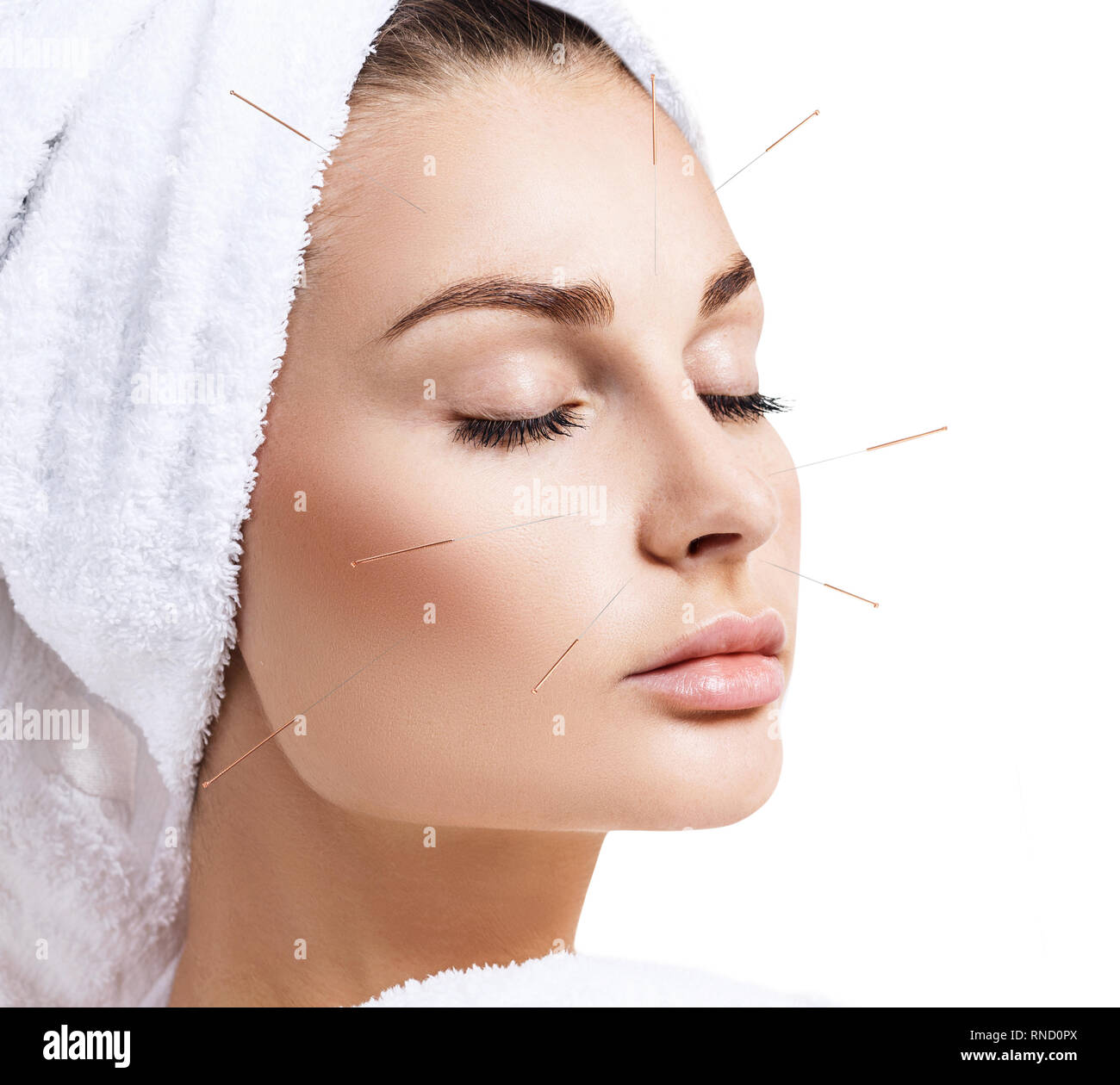 Woman undergoing acupuncture treatment. Stock Photo