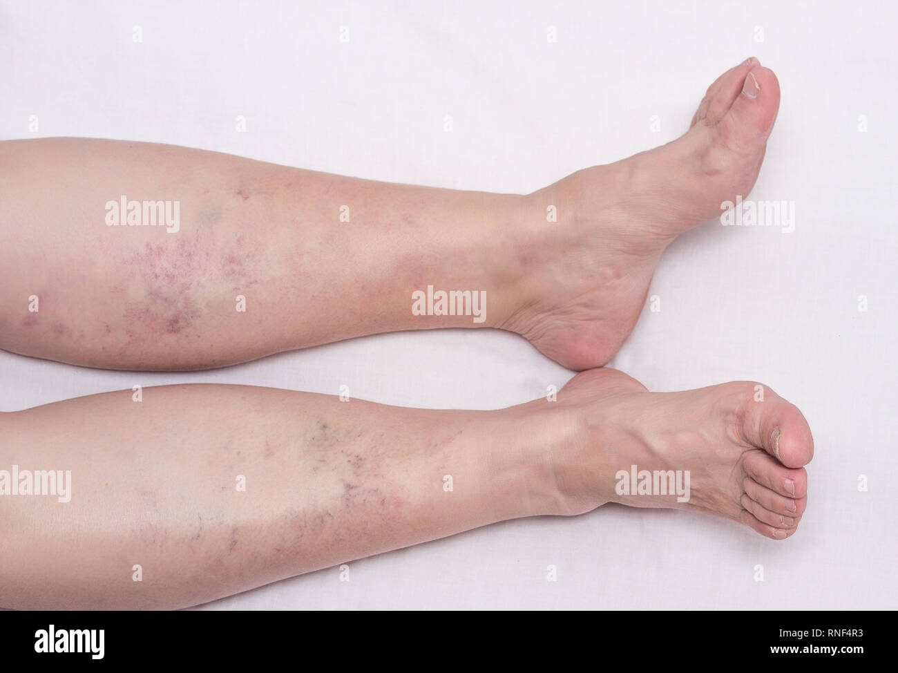 Varicose veins in the legs of a woman, white background, varicose veins on the calves of the