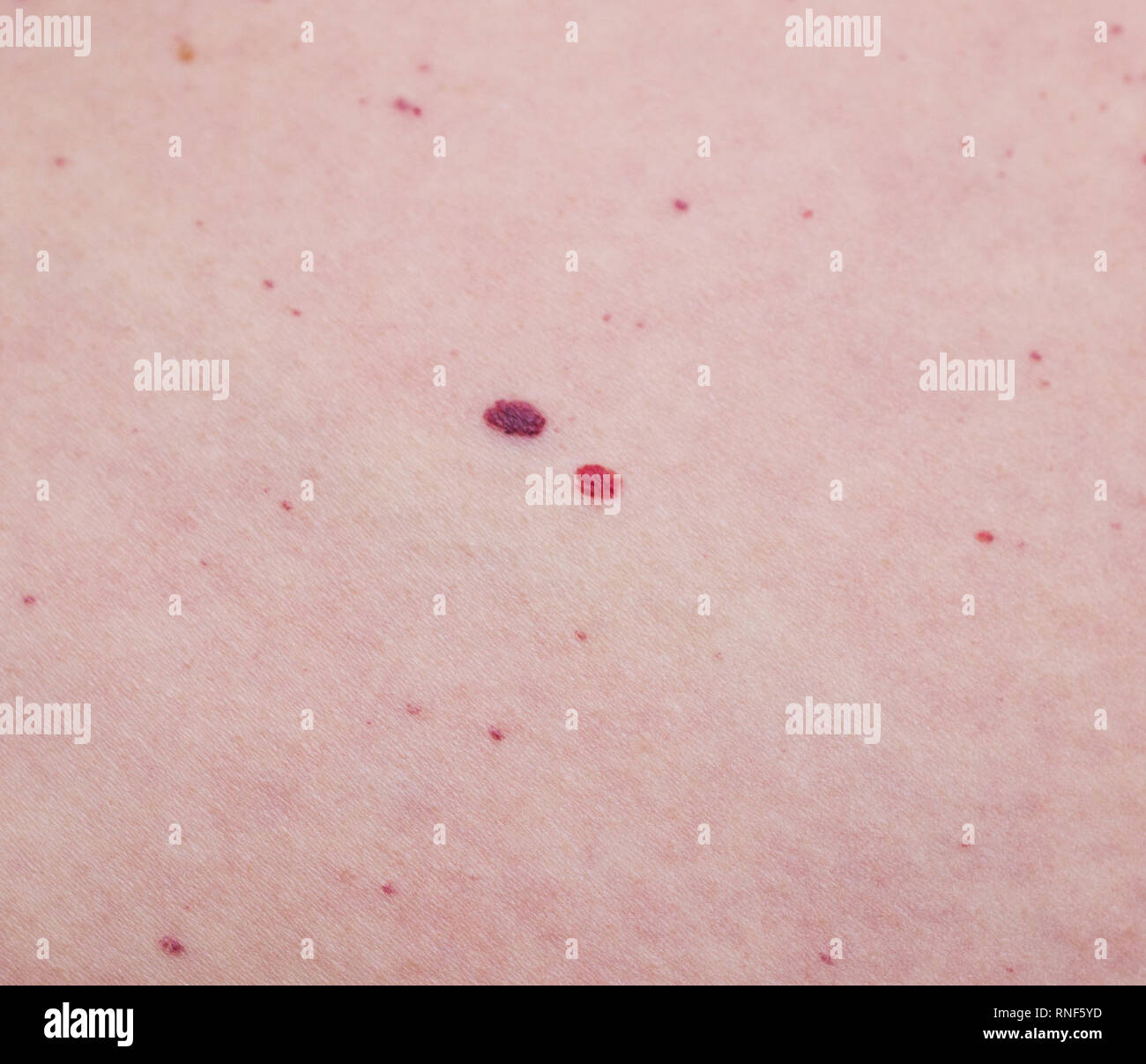 Angioma High Resolution Stock Photography And Images Alamy