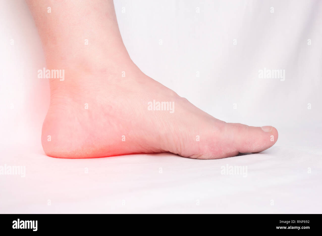 Female leg with a sore heel with a heel spur, spike and osteoite in the heel, pain, close-up, white background, copy space, inflammation, connective t Stock Photo