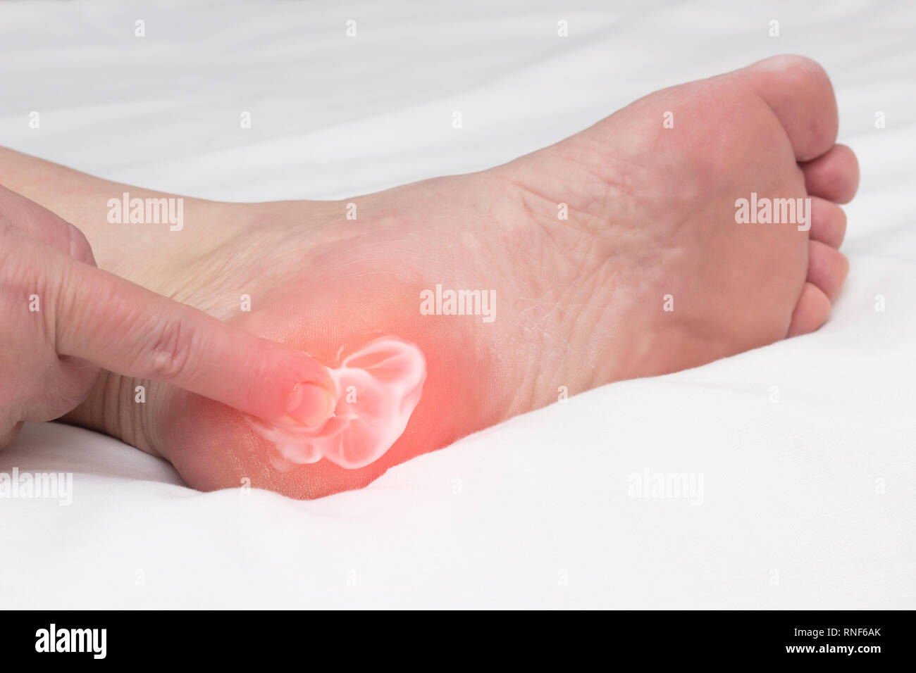 A woman rubs a healing balm cream for the treatment of thorns and osteophytes, a spot spur in the heel, removal of inflammation, close-up, medical, pl Stock Photo