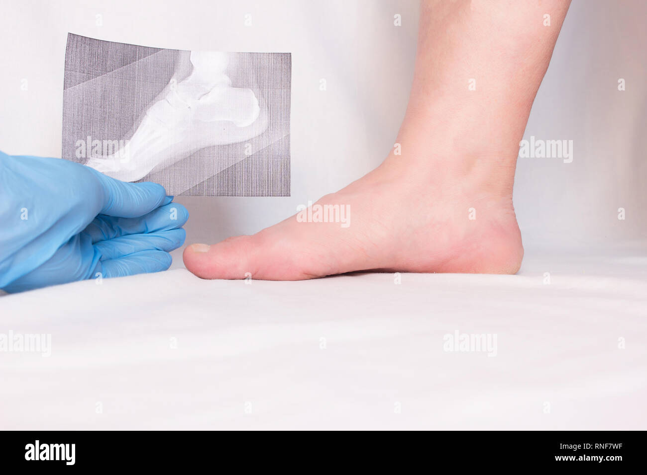 doctor holds x-ray in his hand and examines patient's leg with heel spur, close-up, plantar fasciitis, medical gloves Stock Photo