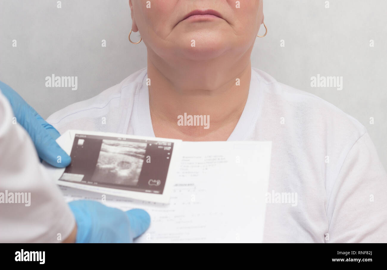 Doctor looks at results of an ultrasound scan of an adult woman's thyroid gland, endocrine system disturbance, close-up, inflammation, hypophysis, car Stock Photo