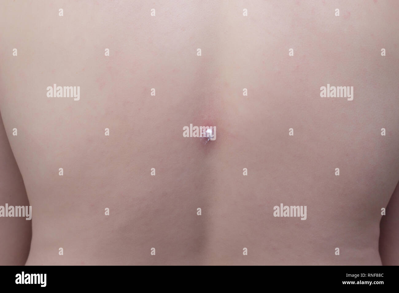 Big Pimple High Resolution Stock Photography And Images Alamy Big Pimple High Resolution Stock Photography And Images Alamy