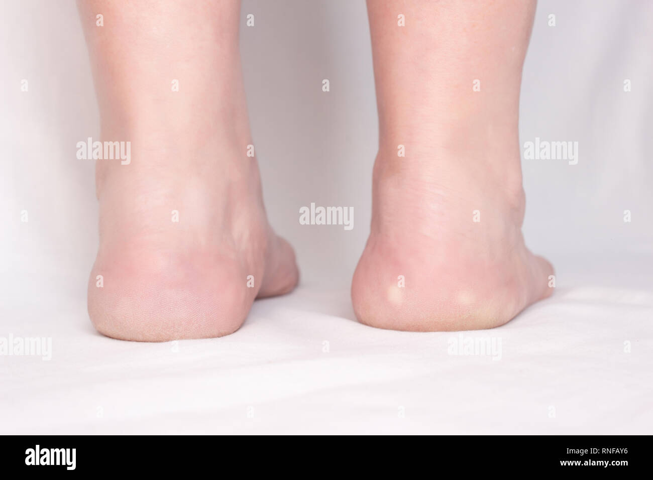 Female feet with spots on a white background with heel spur disease, close-up, plantar fasciitis, osteophyte, inflammation Stock Photo