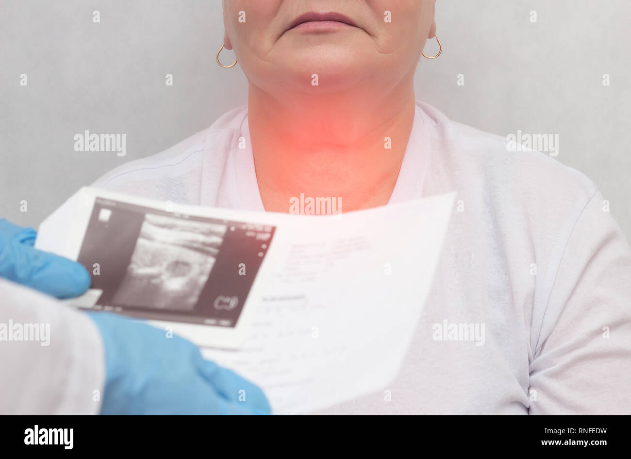 Patient at a doctor with a thyroid disease of the nodular goiter, close-up, medical, pain Stock Photo