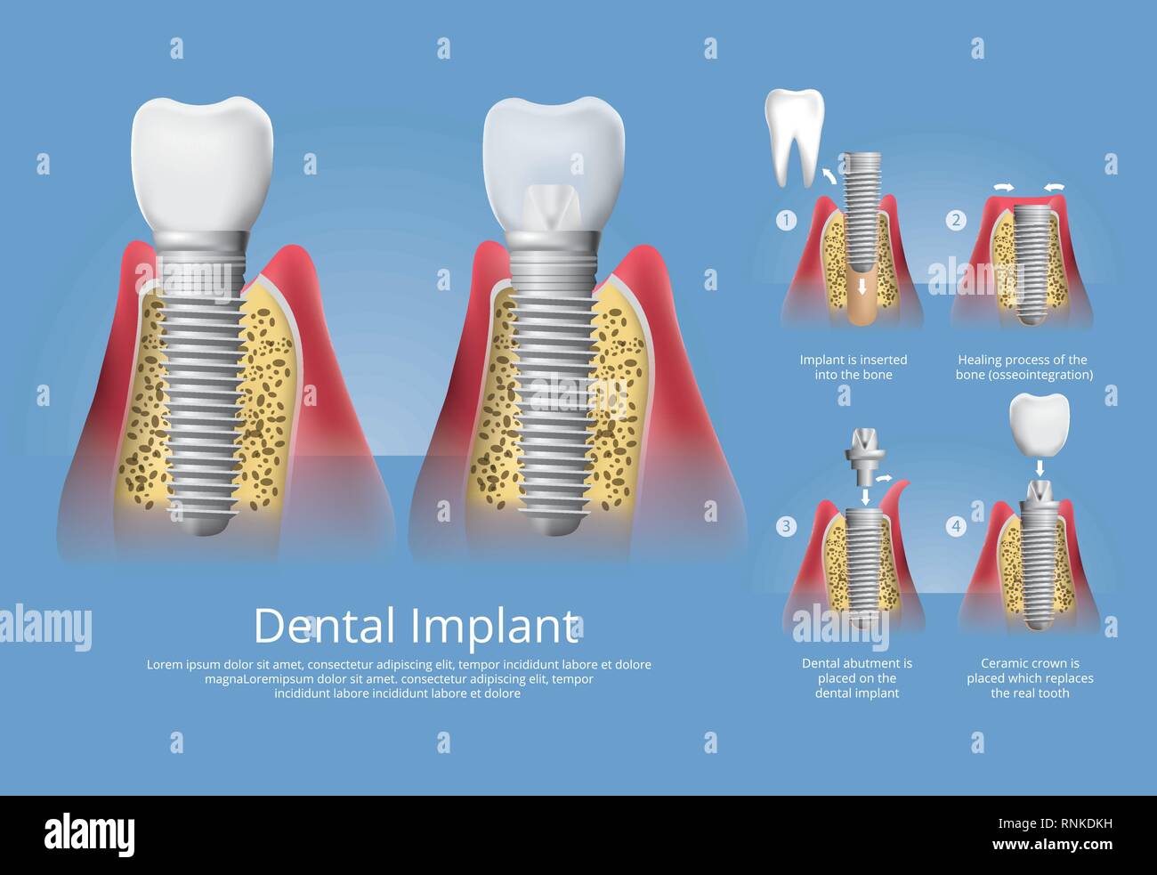 Human teeth and Dental implant Vector Illustration Stock Vector Image ...
