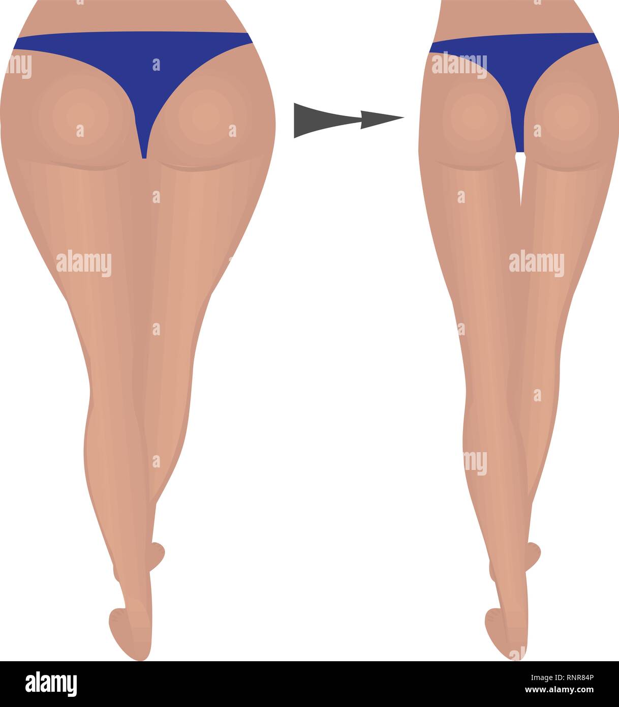 buttocks shape weight loss. Fat and slim thighs hips. before and after vector illustration Stock Vector Image Art Alamy