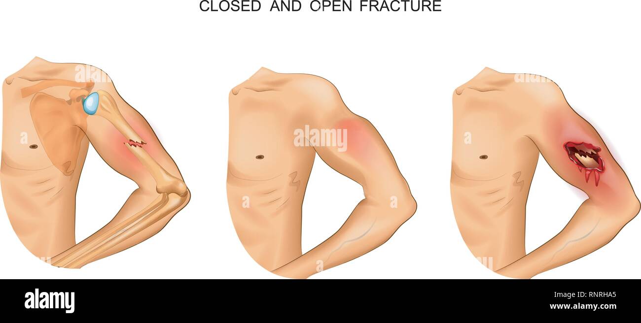 vector illustration of open and closed fracture Stock Vector