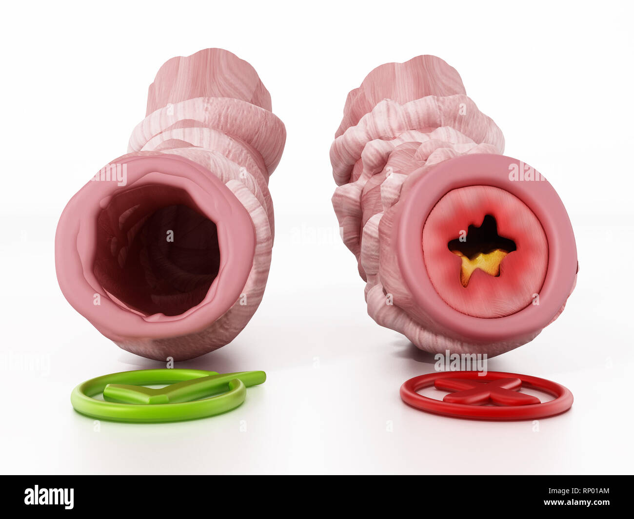 Obstructed and unobstructed bronchial tubes representing asthma. 3D illustration. Stock Photo